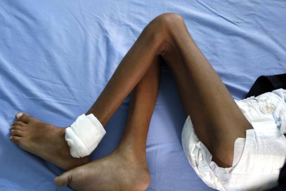 Hungerndes Kind im Jemen