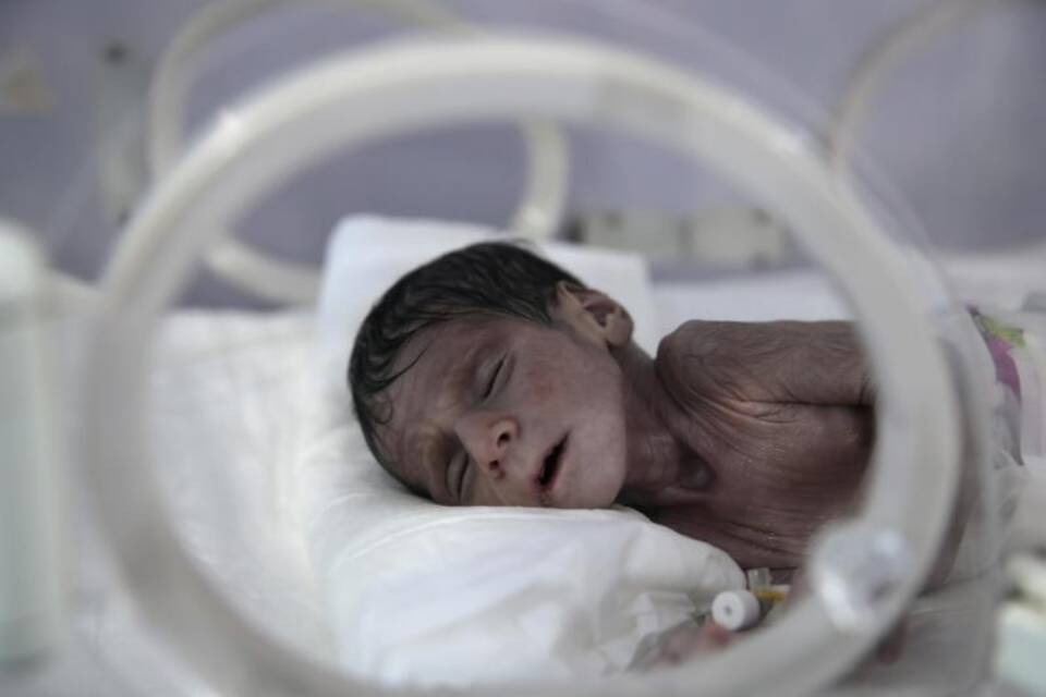 Unterernährte Kinder im Jemen