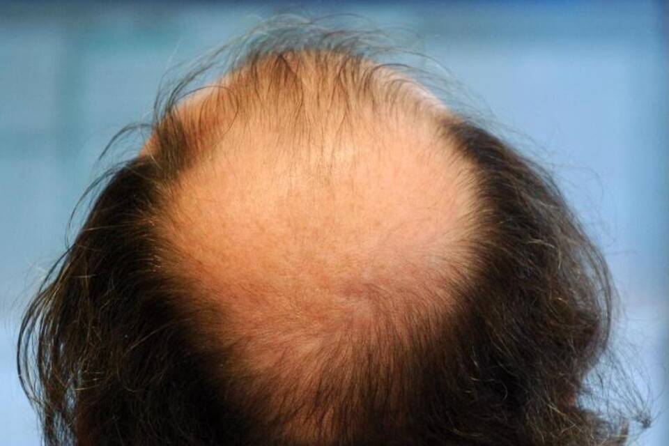 Haarausfall Haarausfall