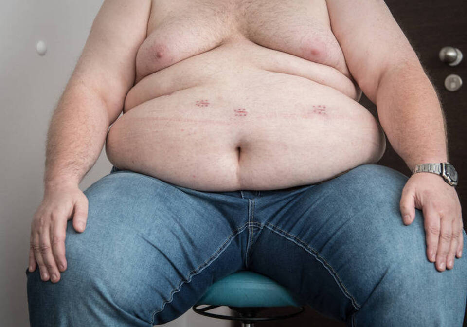Adipositas-Chirurgie: Wenn das Messer die letzte Chance ist Adipositas-Chirurgie: Wenn das Messer die letzte Chance ist