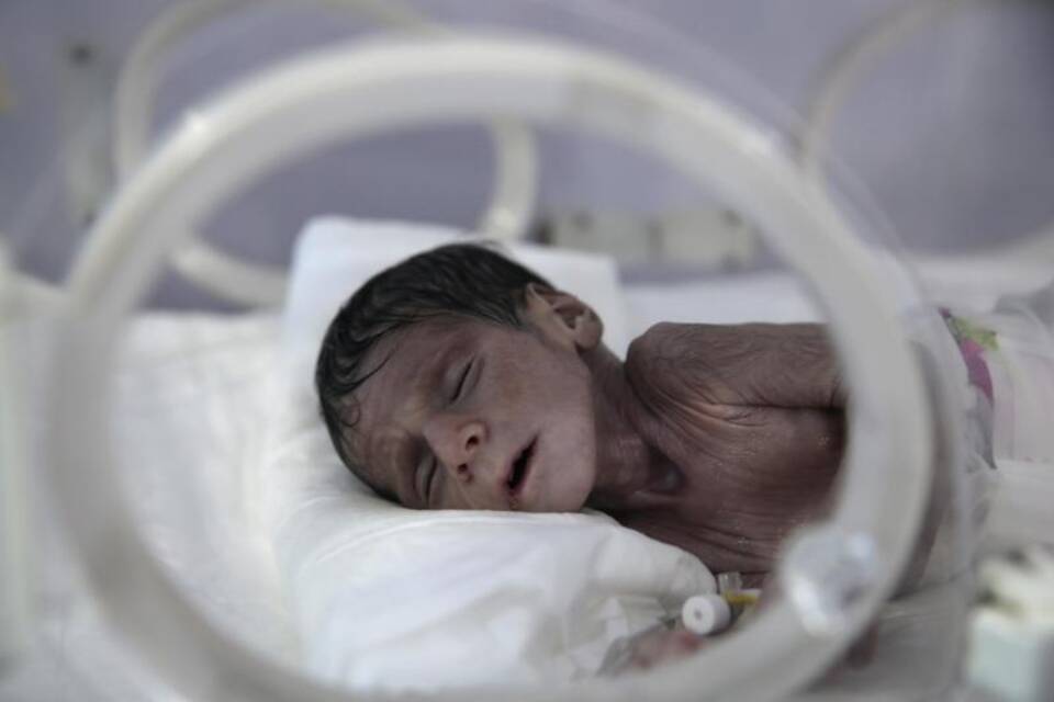 Unterernährtes Kind im Jemen