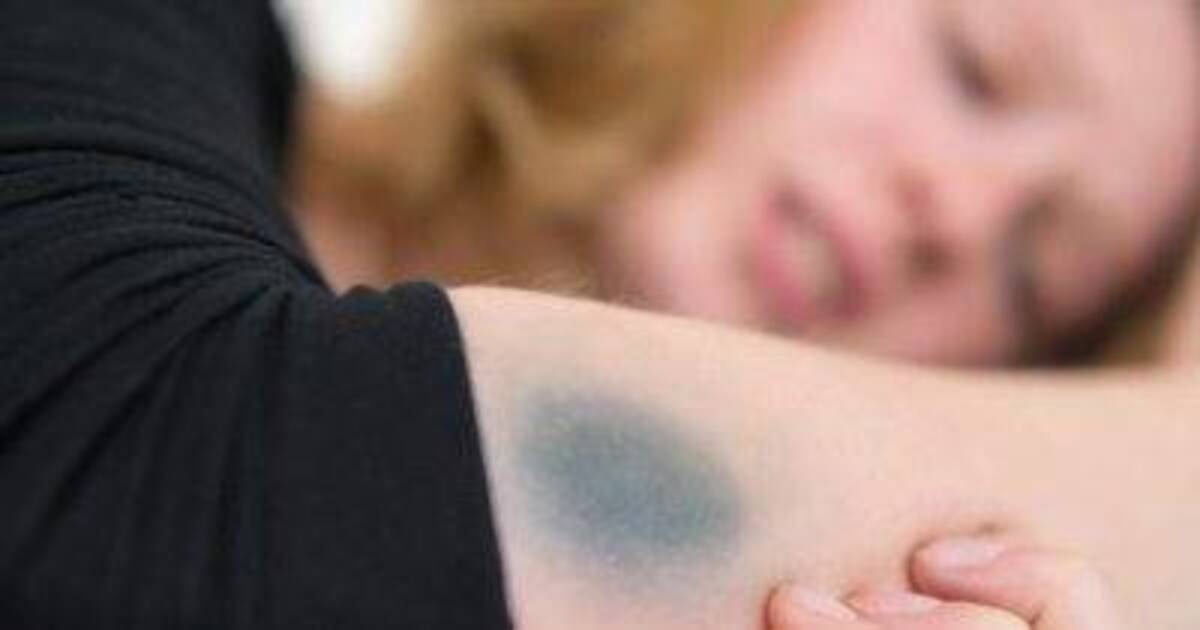 Was tun bei blauen Flecken? Gesundheit RheinNeckarZeitung