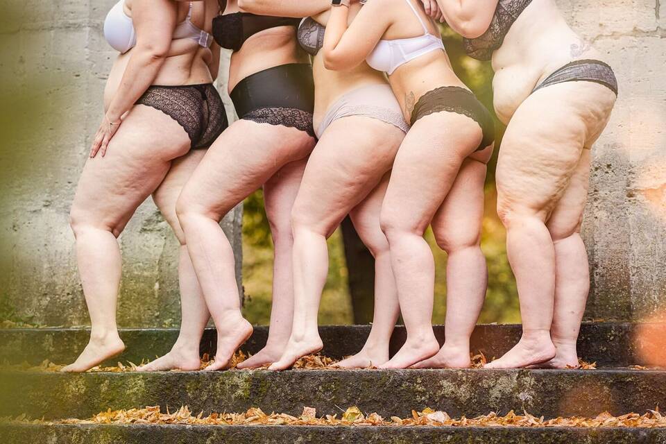 Frauen mit Lipödem-Erkrankung an Beinen Frauen mit Lipödem-Erkrankung an Beinen