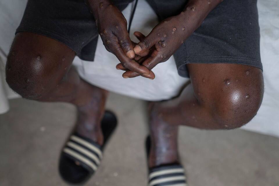 WHO ruft weltweite Notlage wegen Mpox aus WHO ruft weltweite Notlage wegen Mpox aus