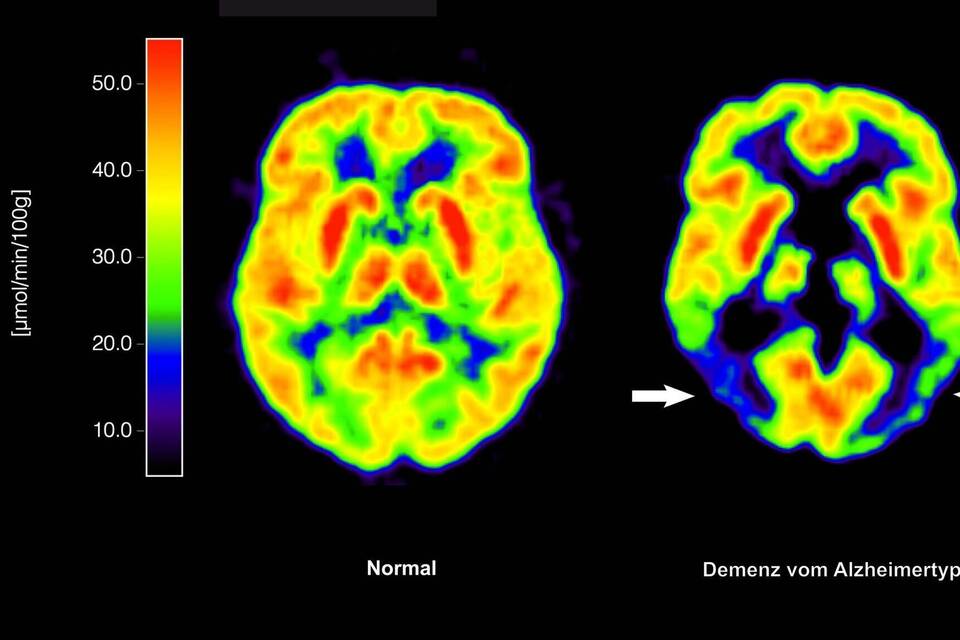 Alzheimer-Erkrankung Alzheimer-Erkrankung