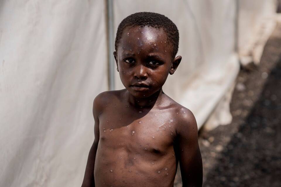 Mpox-Notfallausschuss tagt Mpox-Notfallausschuss tagt