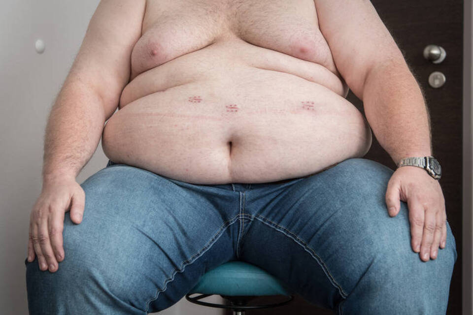Adipositas-Chirurgie: Wenn das Messer die letzte Chance ist Adipositas-Chirurgie: Wenn das Messer die letzte Chance ist