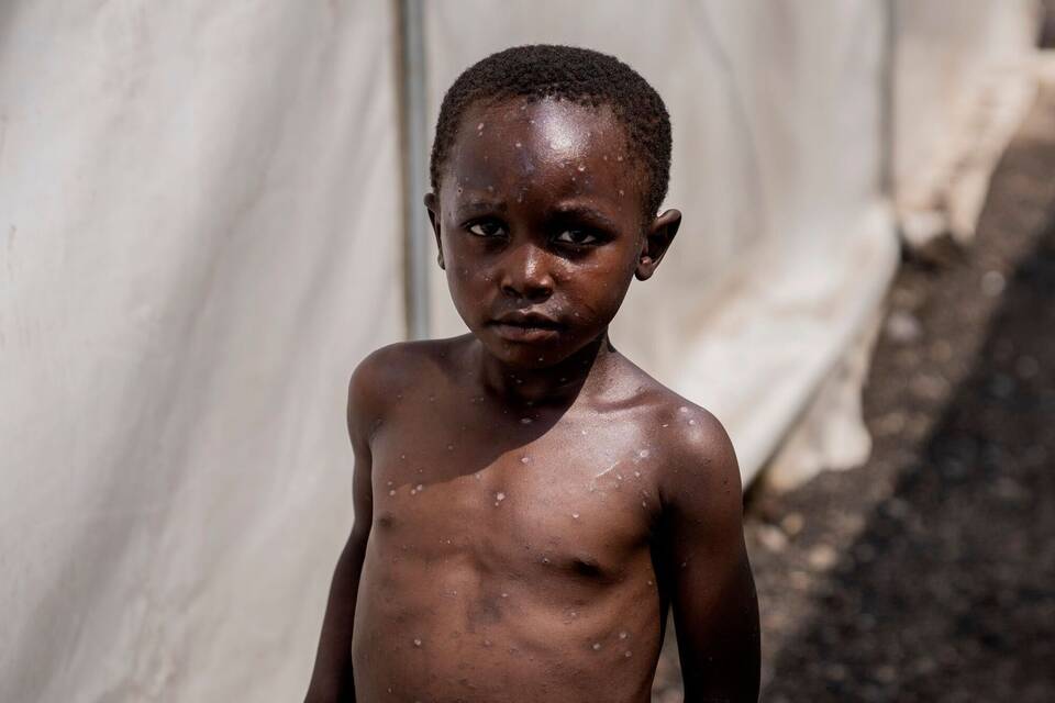 Mpox bleibt internationaler Gesundheitsnotstand Mpox bleibt internationaler Gesundheitsnotstand