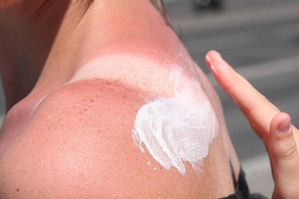 Eine Frau trägt Creme auf einen Sonnenbrand auf