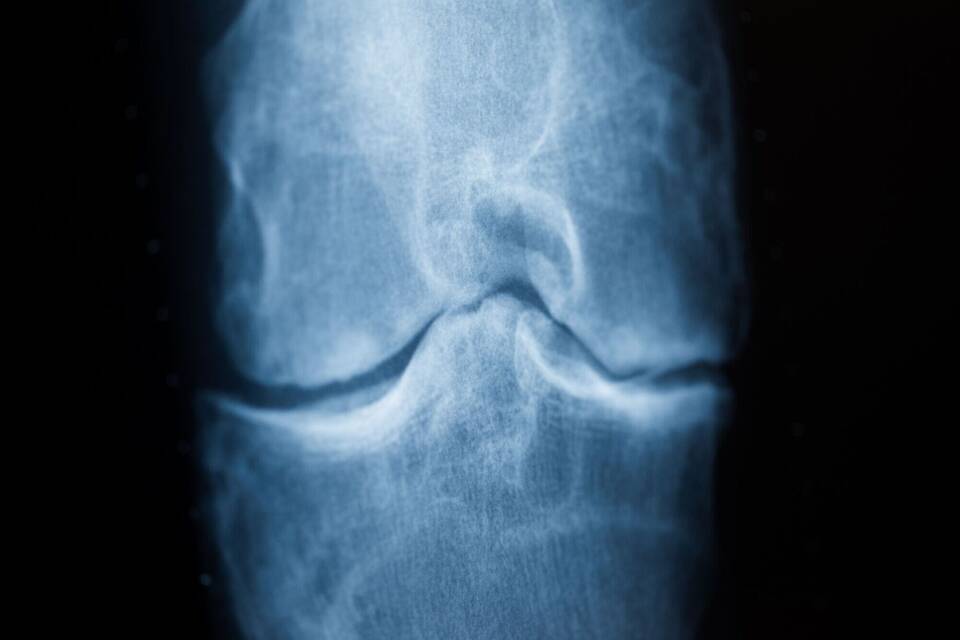 Arthrose