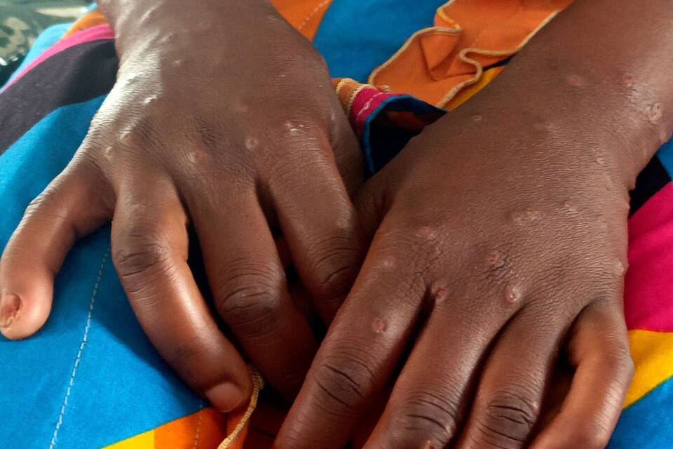 Mpox Mpox