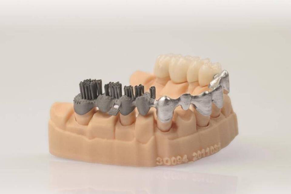 Zahn-Brücke aus dem 3D-Drucker