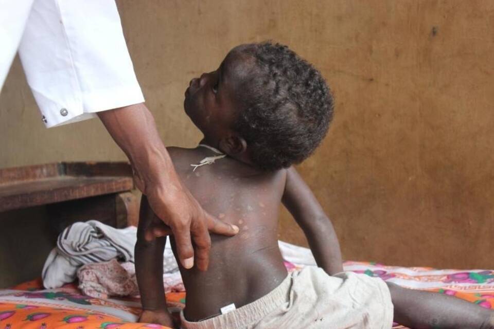 Lepra auf Madagaskar Lepra auf Madagaskar
