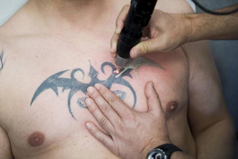 Tattoo-Entfernung Tattoo-Entfernung