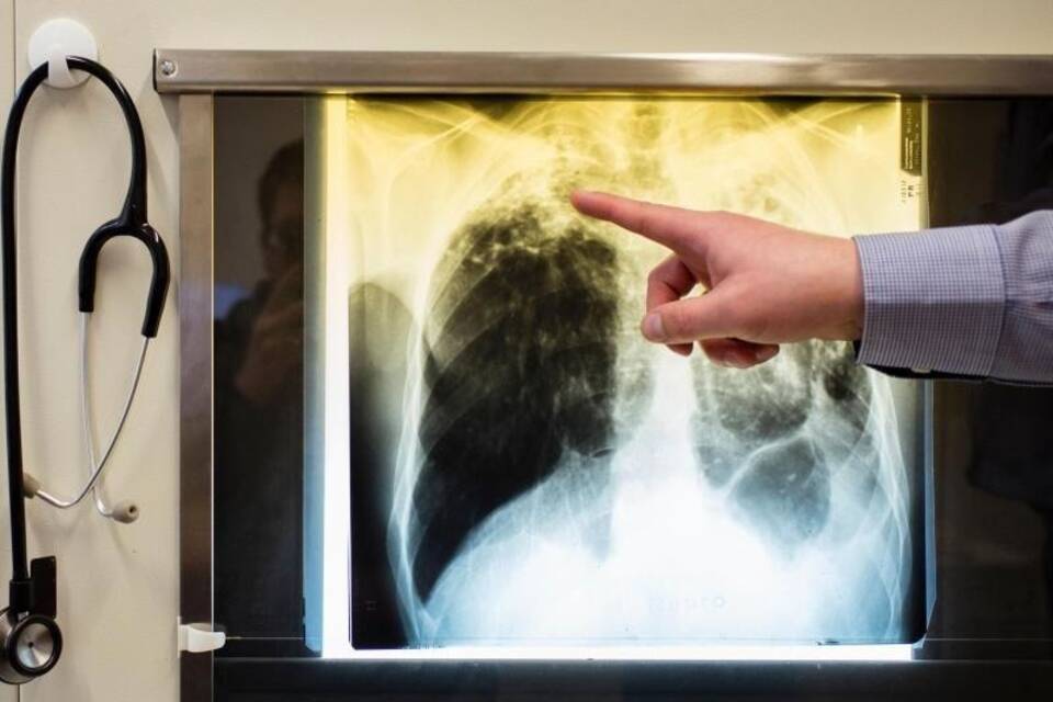 WHO: Zu wenig Fortschritte bei Kampf gegen Tuberkulose WHO: Zu wenig Fortschritte bei Kampf gegen Tuberkulose