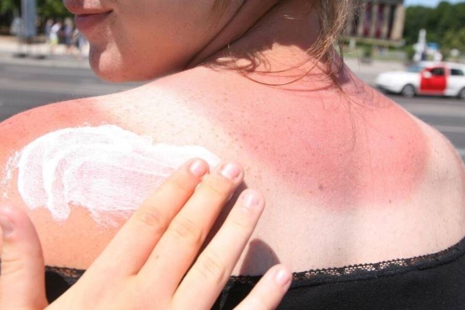 Eine Frau mit Sonnenbrand